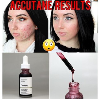 Tinh Chất Serum The Ordinary AHA 30% + BHA 2% Peeling Solution, Mặt Nạ Tẩy Tế Bào Chết 10 Phút Serum Dưỡng Da Xóa Sẹo Mụ