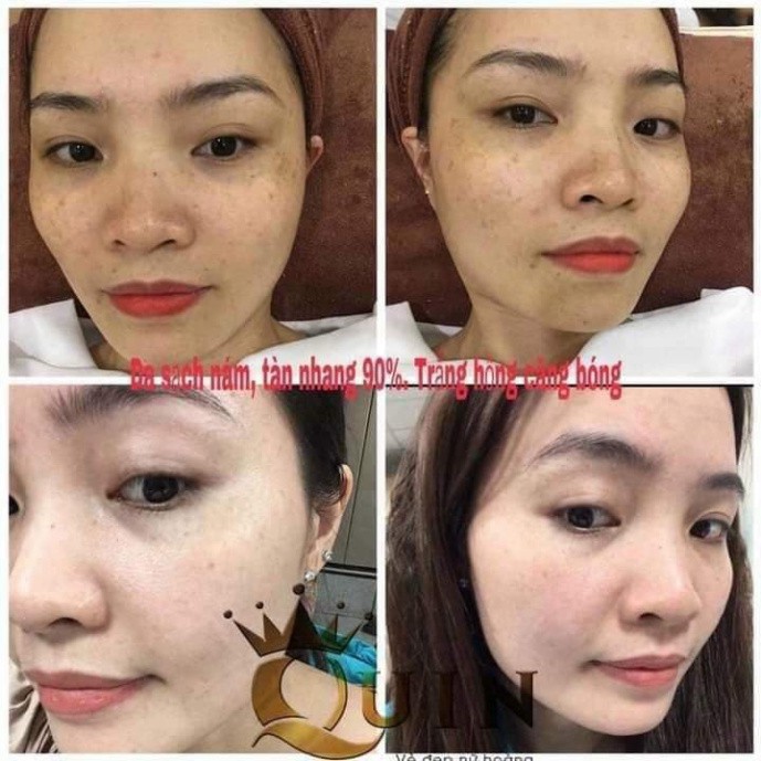 [HÀNG CAO CẤP ] KEM MỜ NÁM QUIN PHIÊN BẢN MỚI 2021 | BigBuy360 - bigbuy360.vn