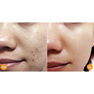 Serum giảm mụn sẹo thâm rỗ LP-II Hàng Chính Hãng | BigBuy360 - bigbuy360.vn