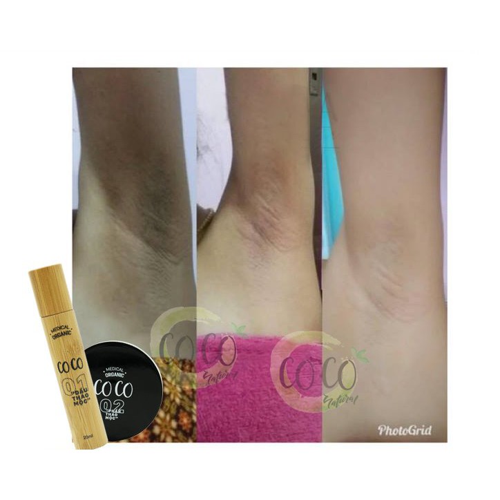Liệu trình trị hôi nách CoCo | BigBuy360 - bigbuy360.vn