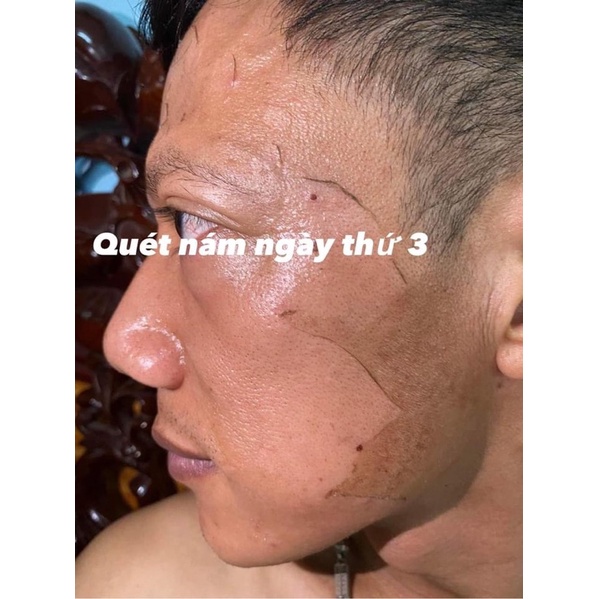 QUÉT NÁM  DR.Nature Peel skin Diamond(tái tạo trẻ hoá da,sáng căng bóng,mờ thâm nám xạm,nhỏ lcl,dùng mọi loại da,...