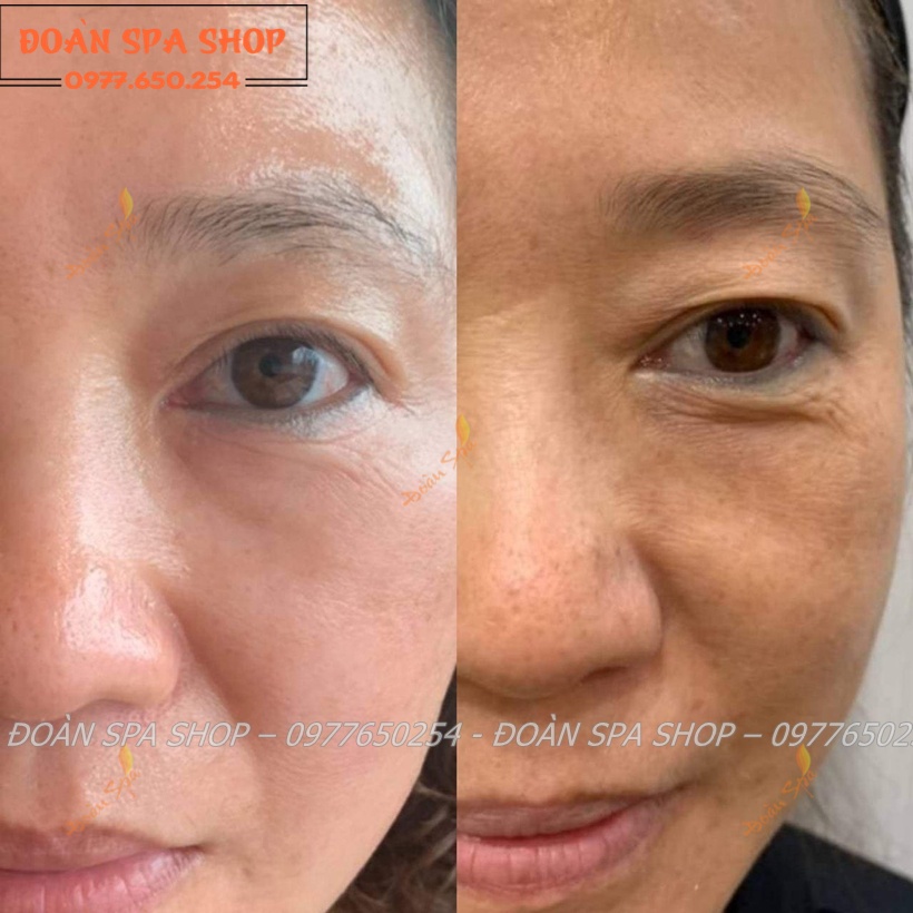 Bộ Phân Hủy Nám Deva Cell - Devacell Luxury
