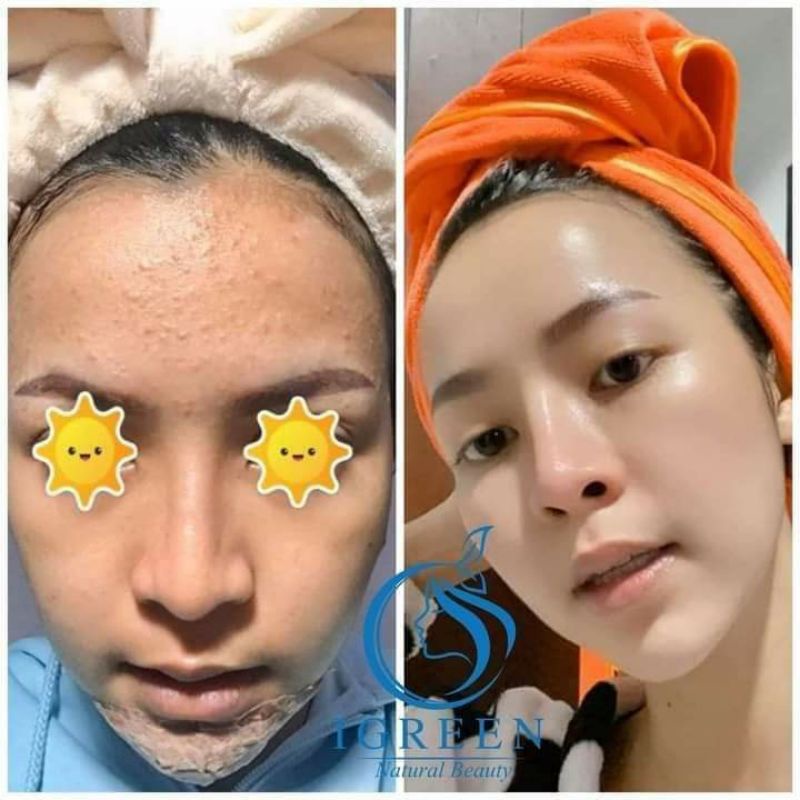 Serum SẠCH MỤN DIẾP CÁ IRGEEN_ GIẢM MỤN, GIẢM THÂM , SE KHÍT LỖ CHÂN LÔNG, SÁNG DA | BigBuy360 - bigbuy360.vn