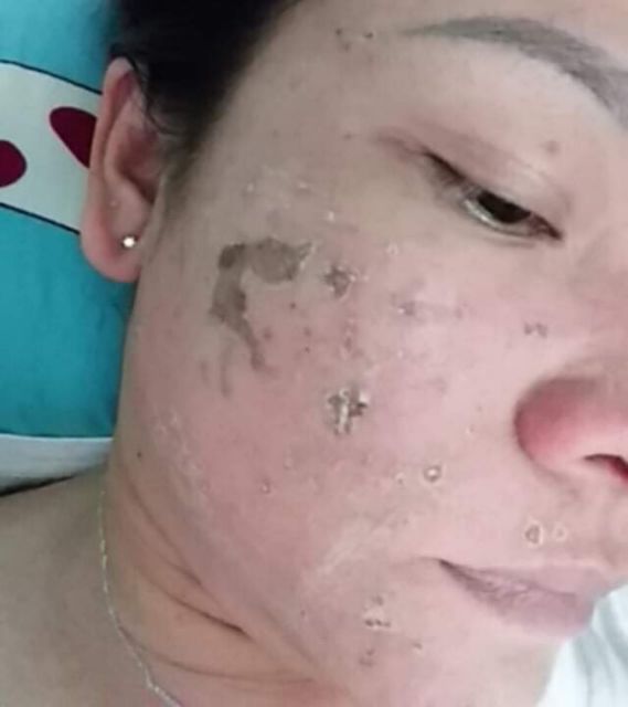 SÉT NHỎ PEEL TCA USA