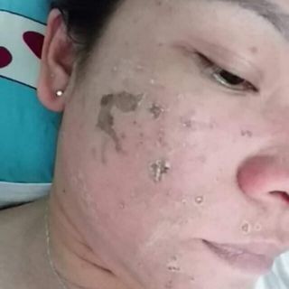 SÉT NHỎ PEEL TCA USA