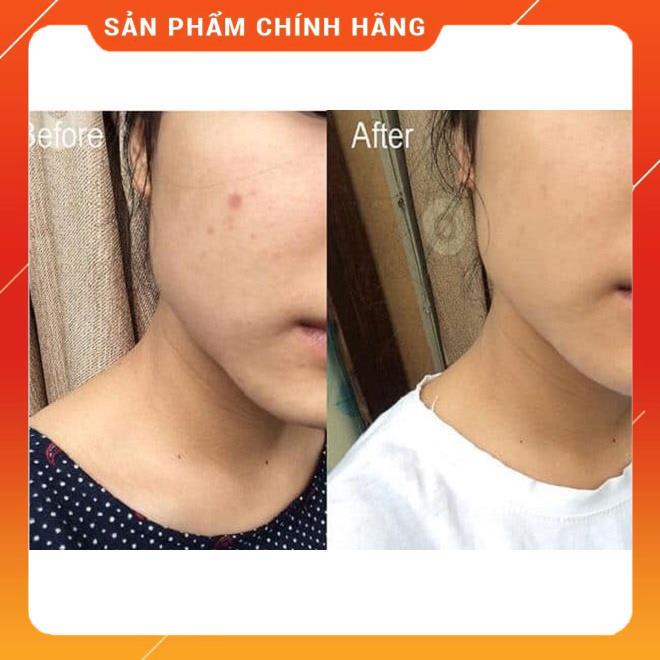 [CHÍNH HÃNG]Tinh Chất Nám Mụn Cc Melano, Serum mờ vết thâm Vitamin C Melano Nhật Bản COSMETIC KOREA