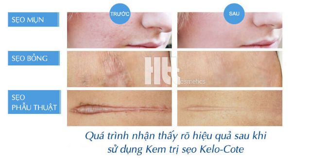 ( Nhập khẩu Mỹ) Gel trị Kelo-cote tuýp 6g và 15g