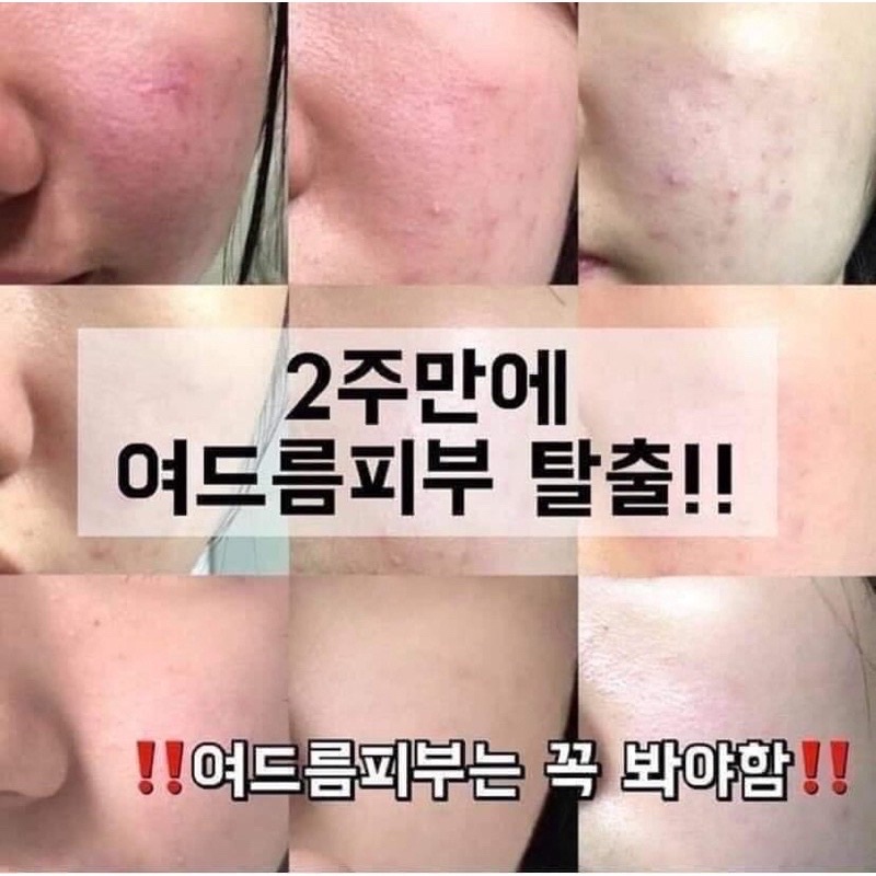Kem Sẹo Noscarna Hàn Quốc