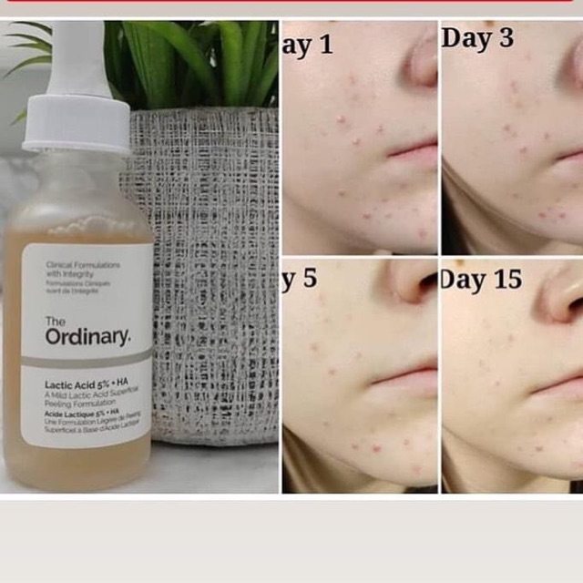[Có Bill] Tinh chất Tẩy Tế Bào Chết - Cấp Nước The Ordinary Serum - Lactic Acid 5%+ HA 2% / Lactic Acid 10%+ HA 2%