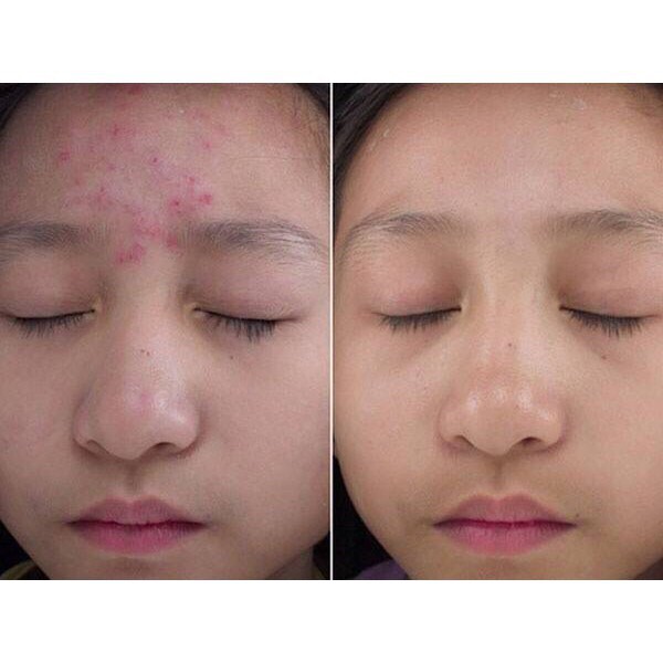 Scar esthetique - Kem sẹo tốt nhất hiện nay