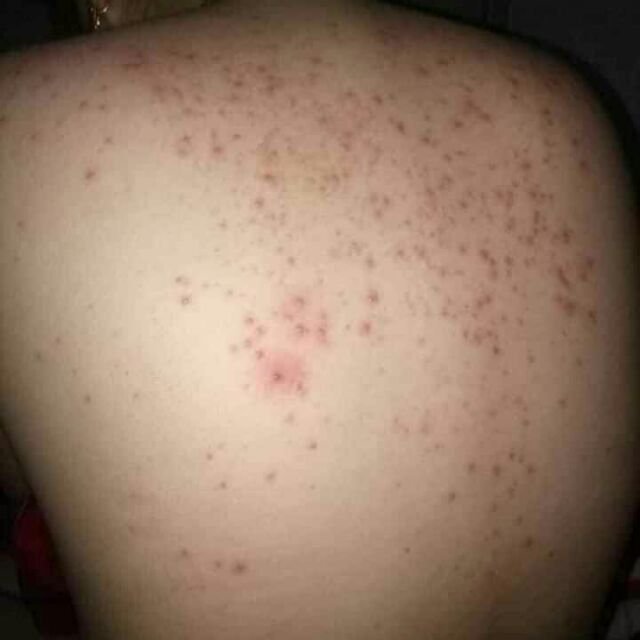 Mụn lưng, viêm lỗ chân lông