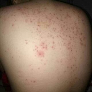 Mụn lưng, viêm lỗ chân lông
