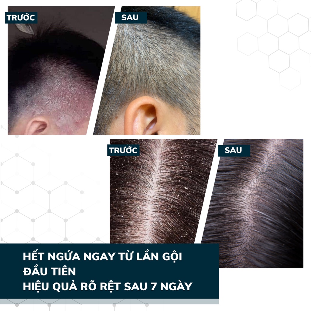 Dầu Gội Đầu DEGO PHARMA 80ml Dứt Điểm Gàu Ngứa & Nấm Da Đầu