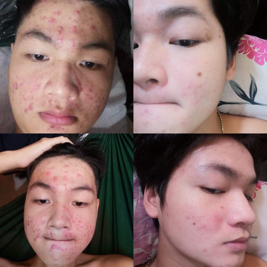 Cốt sâm chuyên mụn thâm nám , tàn nhang ,trắng da , đều màu da  se khít lỗ chân lông