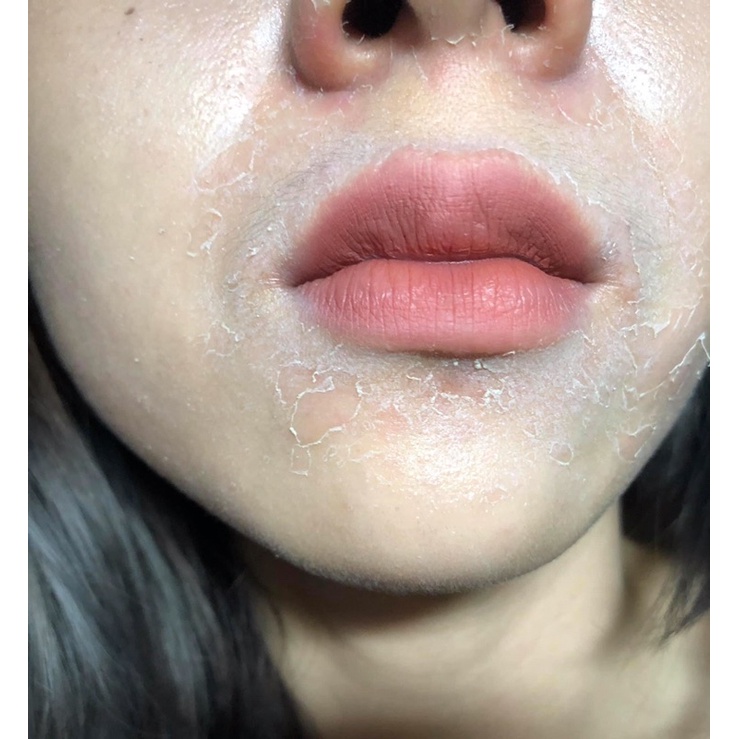 Sỉ 5 chai peel mặt vi tảo