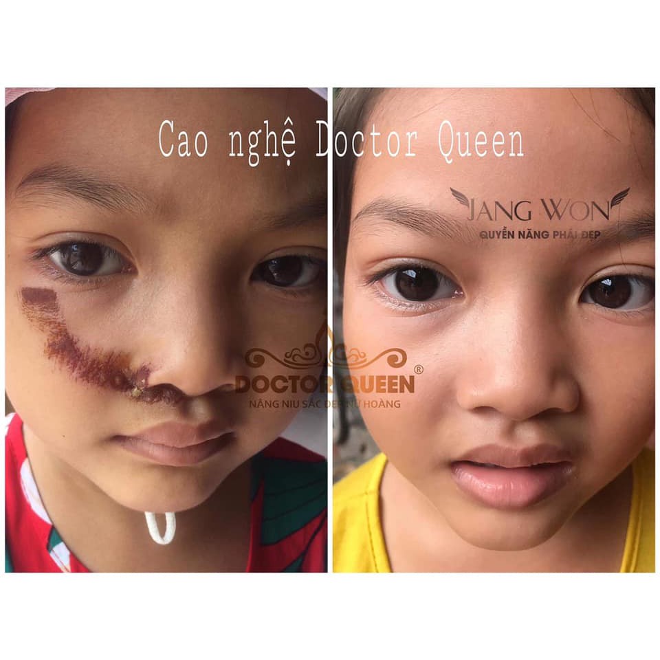 CAO NGHỆ DOCTORQUEEN (ngừa thâm nám,mụn,bỏng,sẹo,ngã xe các vết thương,...làm sáng da,)