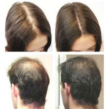 (ORGANIC )Dầu dưỡng tóc của Nga ESVISIN trị chứng hói đầu ngăn ngừa rụng tóc và kích thích mọc tóc