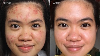 TRỊ MỤN VIÊM BENZAC 5 ( BENZOYL PEROXIDE )
