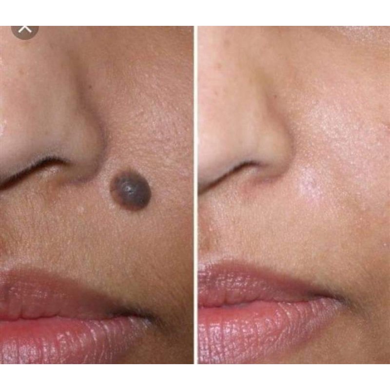 hỗ trợ tẩy mụn ruồi, Mụn cóc,mụn cơm, mắt cá chân vết chai sành | BigBuy360 - bigbuy360.vn