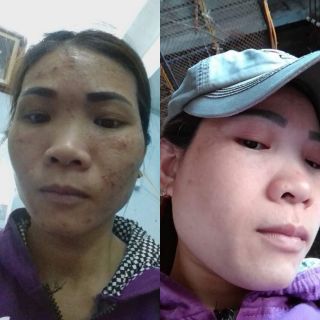 Thảo dược tái tạo da