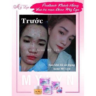 ACNE MỸ LYN (Kèm quà tặng)