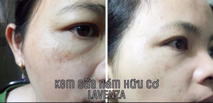 KEM SỮA HỮU CƠ ĐẶC TRỊ NÁM LAVENZA