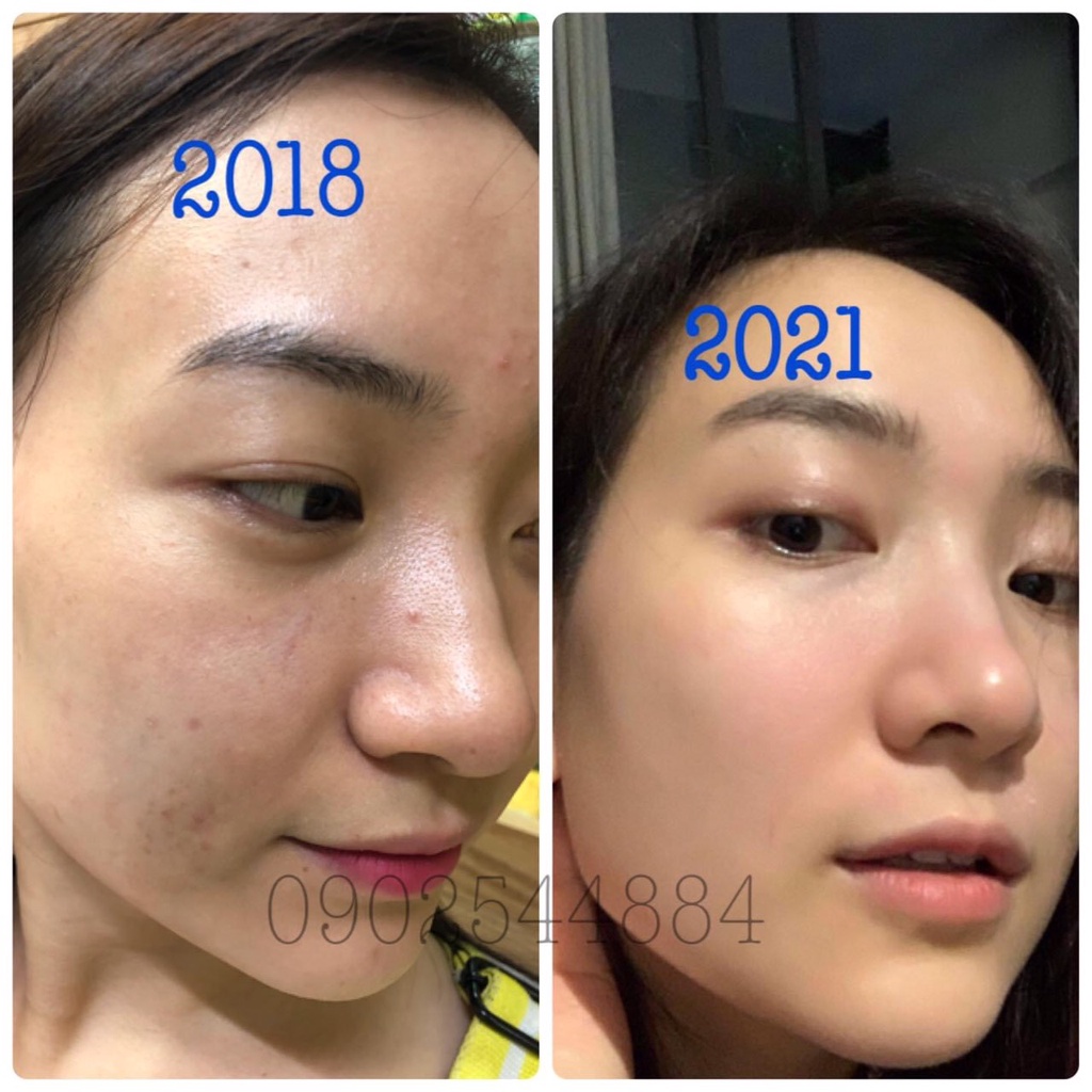 Serum mụn Hoàng Trinh