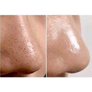 Lột Mụn Cám Đầu Đen