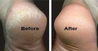 Kem trị nứt gót chân Kpem Nga