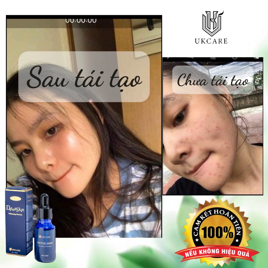 DETOX SKIN – SẠCH MỤN, SẠCH KHUẨN UKCARE | BigBuy360 - bigbuy360.vn