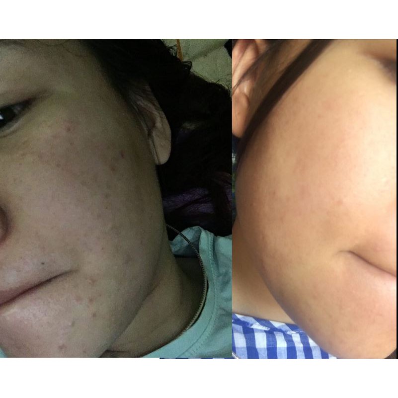 [TẶNG KEM DƯỠNG TRẮNG NGỪA MỤN] Nám Tàn Nhang Nặng Mấy Cũng hết Nhờ em Gel Dr.Skin Này