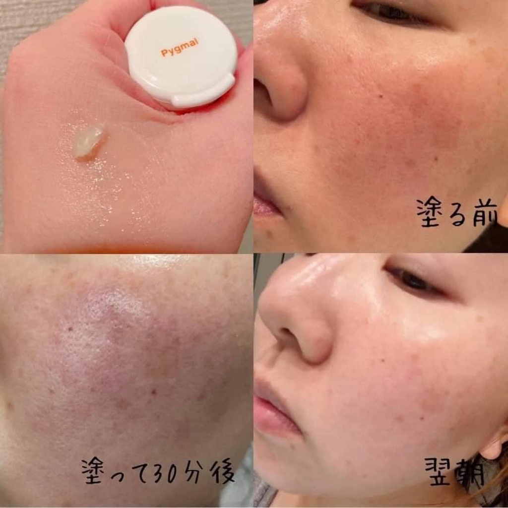 Kem loại nám Civasan Pygmal Professional Peel Cream 5ml