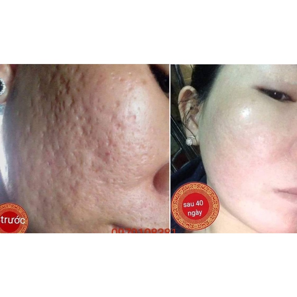 "GIÁ SỐC" Kem sẹo rỗ, sẹo thâm, sẹo rạn , sẹo thủy đậu