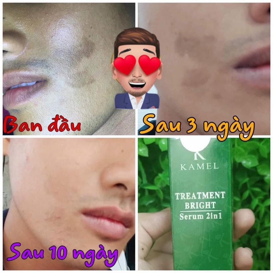 [Sẵn hàng] Treatment Bright Serum 2in1 loại bỏ thâm làm căng bóng trắng da Kamel lọ 10ml | BigBuy360 - bigbuy360.vn