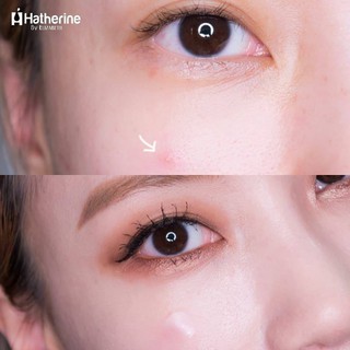 Miếng Dán Mụn Cosrx Đen và Đỏ