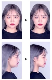 MIẾNG DÁN TẠO MẶT VLINE