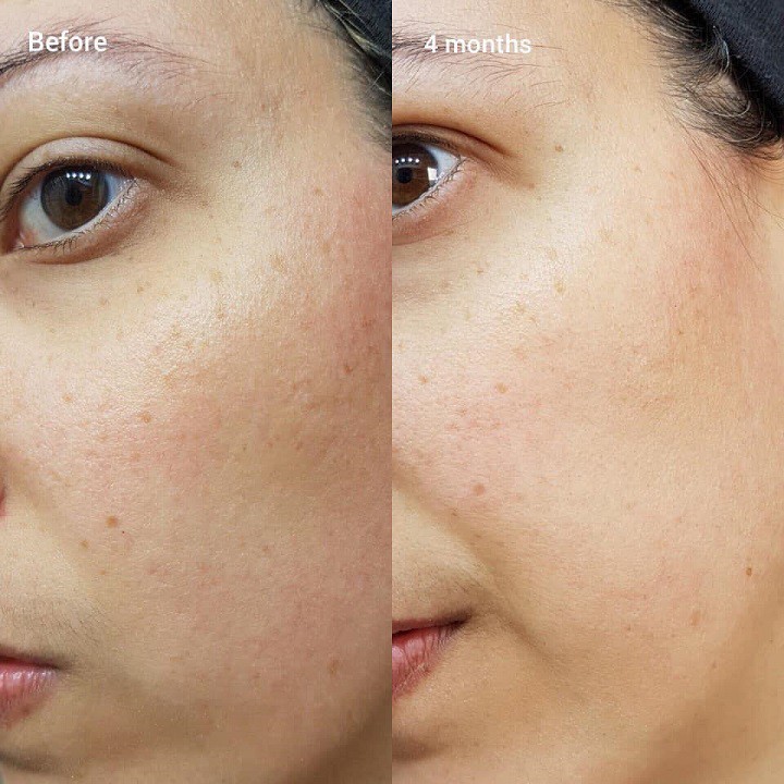 Serum chống lão hóa The Ordinary Retinol 1% in Squalane 30ml