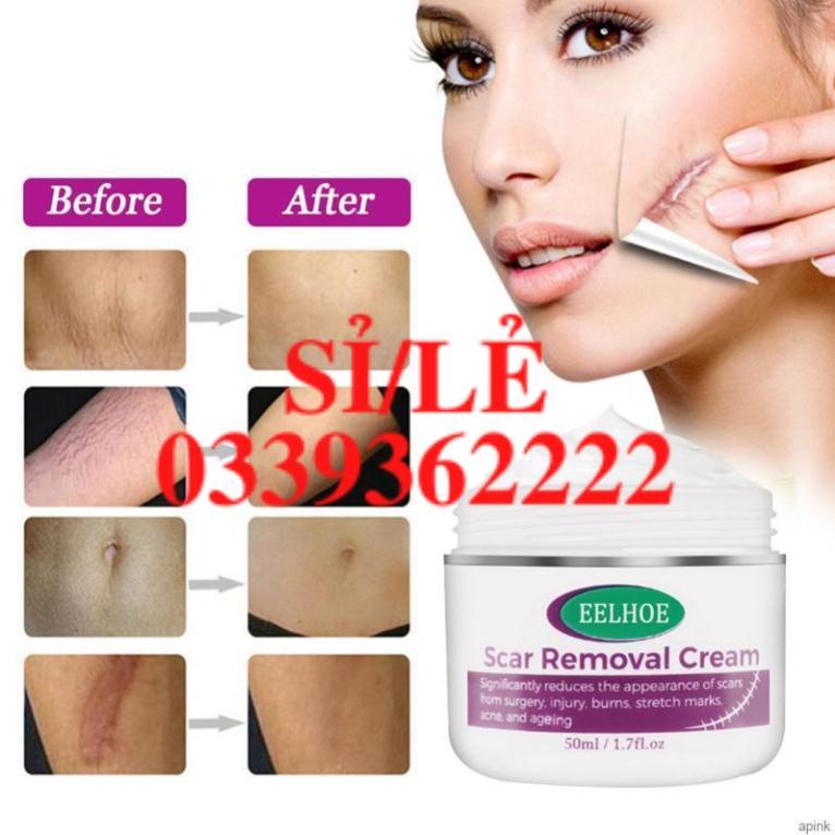 [Hàng mới về] Kem loại bỏ sẹo làm mờ vết rạn da phục hồi làn da 50ml  HAIANHSHOP