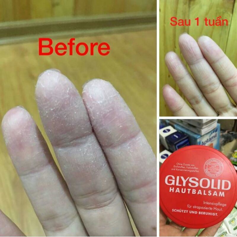 Kem dưỡng da đa năng Glysolid nội địa Đức