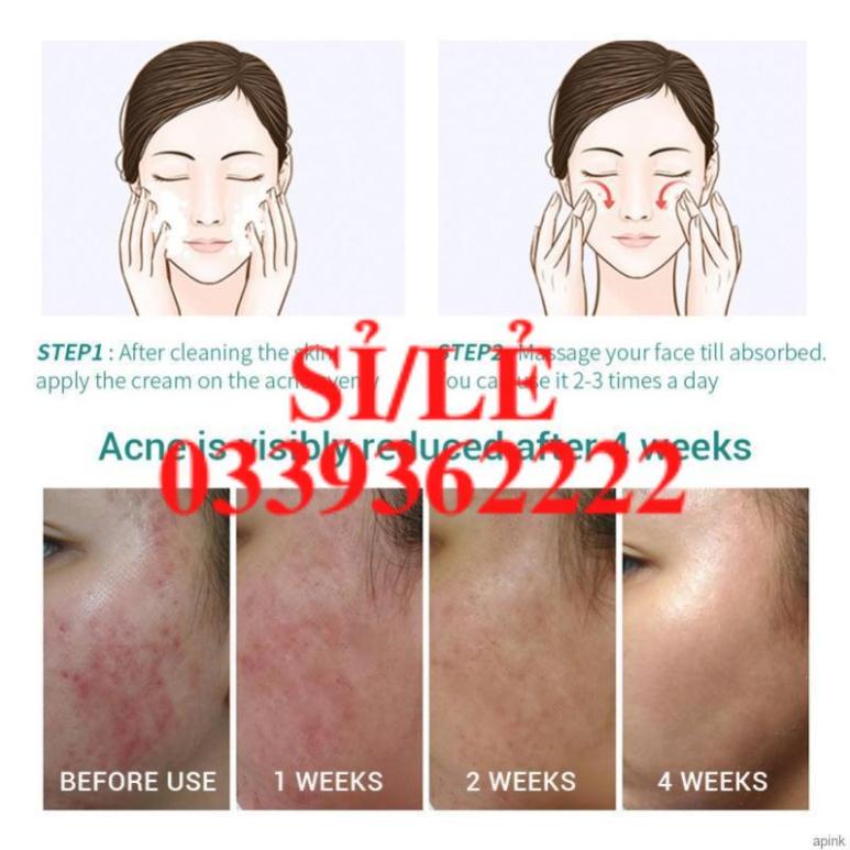 [Hàng mới về] Gel dưỡng da giảm mụn làm mờ sẹo Lanbena 20g  HAIANHSHOP