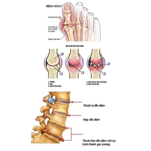 🌸LOẠI MỚI TỐT HƠN🌸 Viên uống xương khớp NOXA Thái Lan