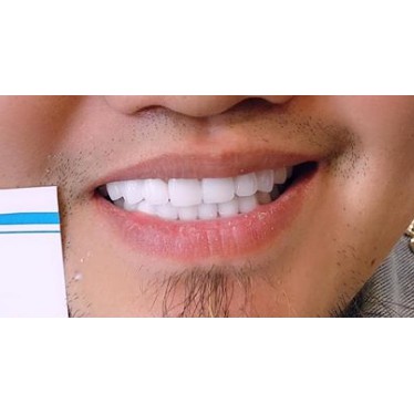 Sứ nhật trắng trong tự nhiên..chống sứt mẻ . Xuống mầu_phủ răng sứ _ trám răng sứ