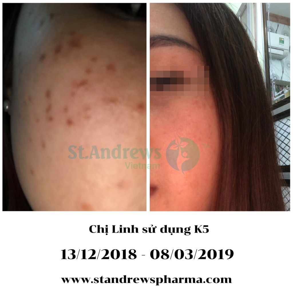 Kem Nám Tàn Nhang K5 Lipogel Hiệu Quả Tốt Nhất Trên Nám Mảng, Sau Sinh, Chân Sâu, Đồi Mồi [CHÍNH HÃNG ITALIA]