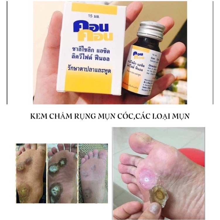 [HÀNG THÁI] KEM CHẤM MỤN CÓC,MUN RUOI, MUN THIT THÁI LAN