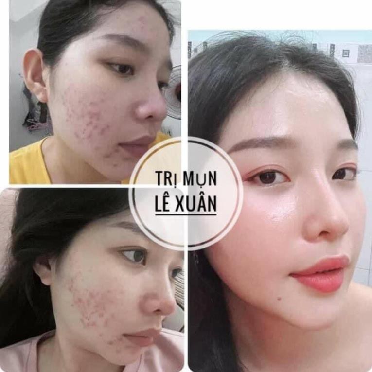 Tinh chất mụn Lê Xuân handmade 130ml | BigBuy360 - bigbuy360.vn