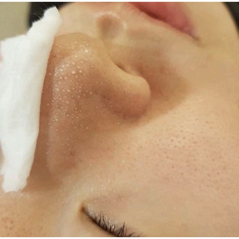 DUNG DỊCH Ủ MỤN MEDIPEEL EXTRA SUPER 9 🌱 | BigBuy360 - bigbuy360.vn