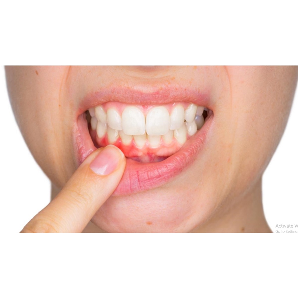 GEL PERIOPLUS DATE 11.2025 chứa Chlorhexidine digluconate0,5% 10ml- hết viêm đau nóng