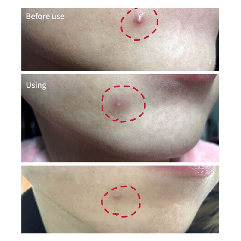 Set 36 Miếng Dán Mặt Trong Suốt Chống Nước Thoáng Khí Tiện Dụng