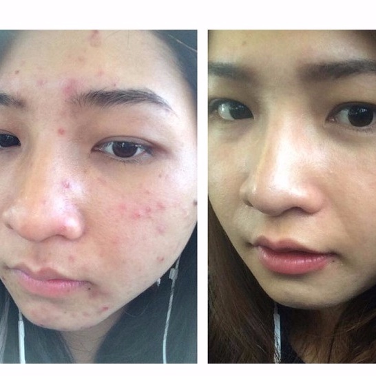 Giảm mụn NC Nga gel lô hội giảm mụn ẩn mụn đầu đen mụn trứng cá mụn cám se khít lỗ chân lông dùng cho da dầu da hỗn hợp