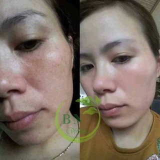 Combo serum collagen, kem face BN White